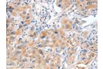 The image on the left is immunohistochemistry of paraffin-embedded Human lung cancer tissue using CSB-PA246246(ACOX2 Antibody) at dilution 1/20, on the right is treated with fusion protein. (Original magnification: 