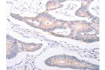The image on the left is immunohistochemistry of paraffin-embedded Human colon cancer tissue using CSB-PA246386(ANKRA2 Antibody) at dilution 1/25, on the right is treated with synthetic peptide. (Original magnification: 