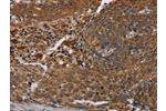 The image on the left is immunohistochemistry of paraffin-embedded Human cervical cancer tissue using CSB-PA247101(FLG Antibody) at dilution 1/20, on the right is treated with synthetic peptide. (Original magnification: 