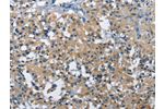 The image on the left is immunohistochemistry of paraffin-embedded Human thyroid cancer tissue using CSB-PA247127(BMPR1B Antibody) at dilution 1/30, on the right is treated with fusion protein. (Original magnification: 