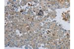 The image on the left is immunohistochemistry of paraffin-embedded Human breast cancer tissue using CSB-PA247166(CKMT1A/CKMT1B Antibody) at dilution 1/100, on the right is treated with synthetic peptide. (Original magnification: 