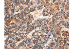 The image on the left is immunohistochemistry of paraffin-embedded Human liver cancer tissue using CSB-PA247335(GJA8 Antibody) at dilution 1/15, on the right is treated with synthetic peptide. (Original magnification: 