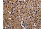 The image on the left is immunohistochemistry of paraffin-embedded Human liver cancer tissue using CSB-PA247539(GNAS Antibody) at dilution 1/30, on the right is treated with fusion protein. (Original magnification: 