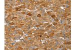 The image on the left is immunohistochemistry of paraffin-embedded Human liver cancer tissue using CSB-PA247700(FTH1 Antibody) at dilution 1/25, on the right is treated with fusion protein. (Original magnification: 