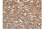 The image on the left is immunohistochemistry of paraffin-embedded Human thyroid cancer tissue using CSB-PA247989(DSTN Antibody) at dilution 1/30, on the right is treated with fusion protein. (Original magnification: 