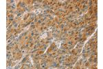 The image on the left is immunohistochemistry of paraffin-embedded Human liver cancer tissue using CSB-PA248001(CYP11B1 Antibody) at dilution 1/30, on the right is treated with fusion protein. (Original magnification: 
