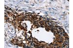 The image on the left is immunohistochemistry of paraffin-embedded Human esophagus cancer tissue using CSB-PA248283(AP1G1 Antibody) at dilution 1/45, on the right is treated with synthetic peptide. (Original magnification: 