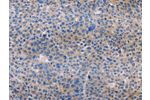 The image on the left is immunohistochemistry of paraffin-embedded Human liver cancer tissue using CSB-PA248410(AMACR Antibody) at dilution 1/30, on the right is treated with fusion protein. (Original magnification: 
