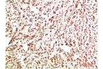Immunohistochemical analysis of paraffin-embedded Human Breast Carcinoma Tissue using Gab1 Rabbit pAb diluted at 1:500
