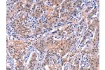 The image on the left is immunohistochemistry of paraffin-embedded Human gastic cancer tissue using CSB-PA249150(EP300 Antibody) at dilution 1/20, on the right is treated with synthetic peptide. (Original magnification: 