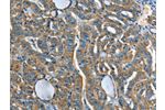 The image on the left is immunohistochemistry of paraffin-embedded Human thyroid cancer tissue using CSB-PA249707(ADCY4 Antibody) at dilution 1/45, on the right is treated with fusion protein. (Original magnification: 