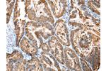 The image on the left is immunohistochemistry of paraffin-embedded Human esophagus cancer tissue using CSB-PA250029(CXCR4 Antibody) at dilution 1/20, on the right is treated with synthetic peptide. (Original magnification: 