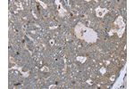 The image on the left is immunohistochemistry of paraffin-embedded Human ovarian cancer tissue using CSB-PA250242(FAR2 Antibody) at dilution 1/40, on the right is treated with fusion protein. (Original magnification: 