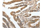 The image on the left is immunohistochemistry of paraffin-embedded Human colon cancer tissue using CSB-PA250828(CKAP2 Antibody) at dilution 1/70, on the right is treated with fusion protein. (Original magnification: 