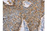 The image on the left is immunohistochemistry of paraffin-embedded Human lung cancer tissue using CSB-PA251431(CDCP1 Antibody) at dilution 1/50, on the right is treated with synthetic peptide. (Original magnification: 