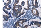 The image on the left is immunohistochemistry of paraffin-embedded Human colon cancer tissue using CSB-PA251438(DUSP6 Antibody) at dilution 1/50, on the right is treated with fusion protein. (Original magnification: 