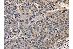 The image on the left is immunohistochemistry of paraffin-embedded Human liver cancer tissue using CSB-PA251527(AFP Antibody) at dilution 1/50, on the right is treated with fusion protein. (Original magnification: 