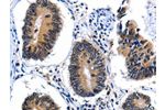 The image on the left is immunohistochemistry of paraffin-embedded Human colon cancer tissue using CSB-PA251962(CEBPG Antibody) at dilution 1/25, on the right is treated with fusion protein. (Original magnification: 