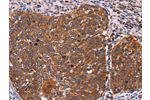 The image on the left is immunohistochemistry of paraffin-embedded Human cervical cancer tissue using CSB-PA251991(FBXW7 Antibody) at dilution 1/40, on the right is treated with fusion protein. (Original magnification: 