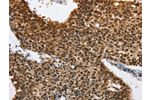 The image on the left is immunohistochemistry of paraffin-embedded Human lung cancer tissue using CSB-PA252158(ELAVL1 Antibody) at dilution 1/40, on the right is treated with fusion protein. (Original magnification: 