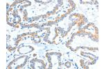 The image on the left is immunohistochemistry of paraffin-embedded Human thyroid cancer tissue using CSB-PA252519(ADAM2 Antibody) at dilution 1/15, on the right is treated with fusion protein. (Original magnification: 