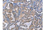 The image on the left is immunohistochemistry of paraffin-embedded Human thyroid cancer tissue using CSB-PA252610(DOK4 Antibody) at dilution 1/50, on the right is treated with fusion protein. (Original magnification: 