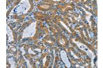 The image on the left is immunohistochemistry of paraffin-embedded Human thyroid cancer tissue using CSB-PA252663(DDAH1 Antibody) at dilution 1/55, on the right is treated with synthetic peptide. (Original magnification: 