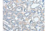 The image on the left is immunohistochemistry of paraffin-embedded Human thyroid cancer tissue using CSB-PA252711(AGBL2 Antibody) at dilution 1/25, on the right is treated with fusion protein. (Original magnification: 