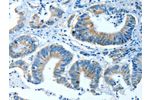 The image on the left is immunohistochemistry of paraffin-embedded Human colon cancer tissue using CSB-PA252846(ALDH4A1 Antibody) at dilution 1/35, on the right is treated with fusion protein. (Original magnification: 