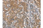 The image on the left is immunohistochemistry of paraffin-embedded Human gastic cancer tissue using CSB-PA253255(ACPT Antibody) at dilution 1/25, on the right is treated with synthetic peptide. (Original magnification: 