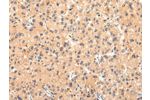 The image on the left is immunohistochemistry of paraffin-embedded Human liver cancer tissue using CSB-PA253608(ATP7B  Antibody) at dilution 1/20, on the right is treated with synthetic peptide. (Original magnification: 