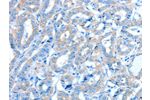 The image on the left is immunohistochemistry of paraffin-embedded Human thyroid cancer tissue using CSB-PA254568(ALDH3B1 Antibody) at dilution 1/30, on the right is treated with fusion protein. (Original magnification: 