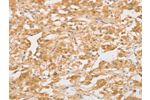 The image on the left is immunohistochemistry of paraffin-embedded Human thyroid cancer tissue using CSB-PA254759(CD24 Antibody) at dilution 1/40, on the right is treated with synthetic peptide. (Original magnification: 