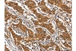 The image on the left is immunohistochemistry of paraffin-embedded Human gastic cancer tissue using CSB-PA254762(CYP2B6 Antibody) at dilution 1/25, on the right is treated with synthetic peptide. (Original magnification: 