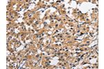 The image on the left is immunohistochemistry of paraffin-embedded Human thyroid cancer tissue using CSB-PA254797(CLEC2D Antibody) at dilution 1/70, on the right is treated with fusion protein. (Original magnification: 