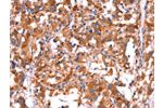 The image on the left is immunohistochemistry of paraffin-embedded Human thyroid cancer tissue using CSB-PA254989(GCG Antibody) at dilution 1/40, on the right is treated with synthetic peptide. (Original magnification: 