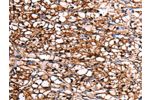 The image on the left is immunohistochemistry of paraffin-embedded Human renal cancer tissue using CSB-PA255283(GDF15 Antibody) at dilution 1/7, on the right is treated with fusion protein. (Original magnification: 