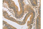 The image on the left is immunohistochemistry of paraffin-embedded Human colon cancer tissue using CSB-PA255560(ARHGEF1 Antibody) at dilution 1/60, on the right is treated with fusion protein. (Original magnification: 