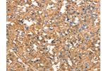 The image on the left is immunohistochemistry of paraffin-embedded Human thyroid cancer tissue using CSB-PA255746(CRELD1 Antibody) at dilution 1/40, on the right is treated with synthetic peptide. (Original magnification: 