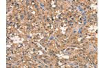 The image on the left is immunohistochemistry of paraffin-embedded Human thyroid cancer tissue using CSB-PA256217(CRELD1 Antibody) at dilution 1/40, on the right is treated with synthetic peptide. (Original magnification: 