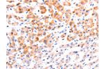 The image on the left is immunohistochemistry of paraffin-embedded Human liver cancer tissue using CSB-PA256498(EFNA1 Antibody) at dilution 1/37, on the right is treated with fusion protein. (Original magnification: 