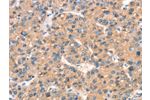 The image on the left is immunohistochemistry of paraffin-embedded Human liver cancer tissue using CSB-PA256995(ARHGAP4 Antibody) at dilution 1/25, on the right is treated with synthetic peptide. (Original magnification: 