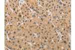 The image on the left is immunohistochemistry of paraffin-embedded Human liver cancer tissue using CSB-PA257054(ARMCX1 Antibody) at dilution 1/40, on the right is treated with fusion protein. (Original magnification: 