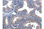 The image on the left is immunohistochemistry of paraffin-embedded Human cervical cancer tissue using CSB-PA257161(APAF1 Antibody) at dilution 1/25, on the right is treated with synthetic peptide. (Original magnification: 