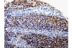 The image is immunohistochemistry of paraffin-embedded Human renal cancer tissue using CSB-PA257877(COX10 Antibody) at dilution 1/100. (Original magnification: 200)