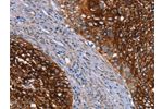 The image on the left is immunohistochemistry of paraffin-embedded Human cervical cancer tissue using CSB-PA257925(CRH Antibody) at dilution 1/20, on the right is treated with synthetic peptide. (Original magnification: 
