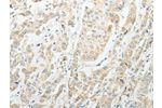 The image on the left is immunohistochemistry of paraffin-embedded Human breast cancer tissue using CSB-PA257995(AGBL1 Antibody) at dilution 1/15, on the right is treated with synthetic peptide. (Original magnification: 