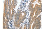 The image on the left is immunohistochemistry of paraffin-embedded Human colon cancer tissue using CSB-PA258870(CENPC Antibody) at dilution 1/70, on the right is treated with fusion protein. (Original magnification: 