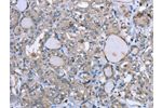 The image on the left is immunohistochemistry of paraffin-embedded Human thyroid cancer tissue using CSB-PA258899(FCAR Antibody) at dilution 1/20, on the right is treated with fusion protein. (Original magnification: 