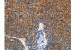 The image on the left is immunohistochemistry of paraffin-embedded Human liver cancer tissue using CSB-PA258902(AUP1 Antibody) at dilution 1/50, on the right is treated with fusion protein. (Original magnification: 